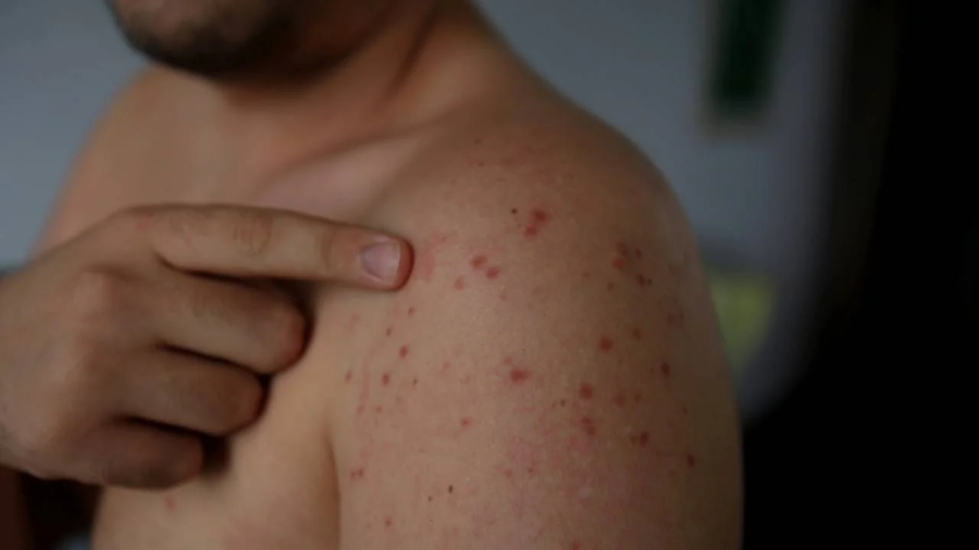 Ministério da Saúde alerta para risco de aumento de casos de sarampo após a Copa do Mundo